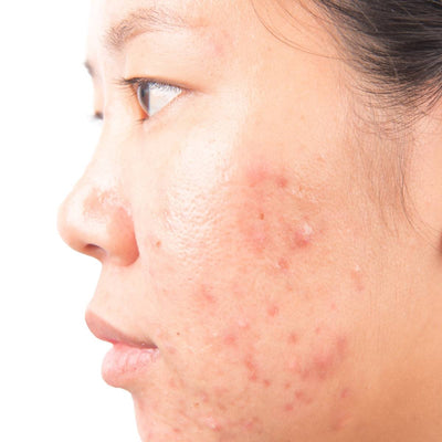 Hormonal Acne, Explained