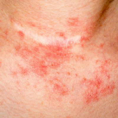 Eczema, Explained