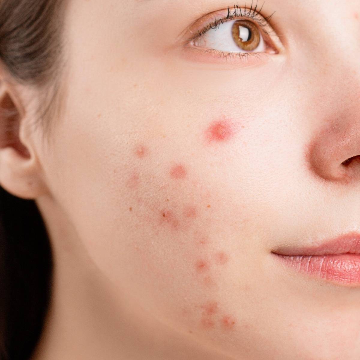 acne red light