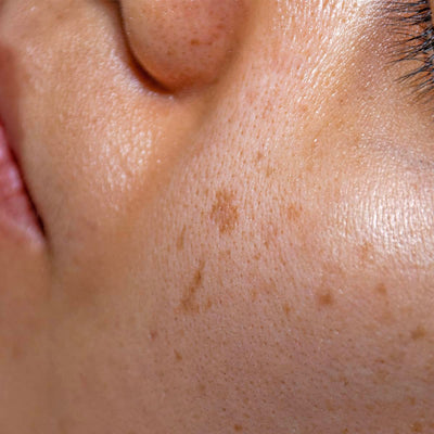 Hyperpigmentation, Explained