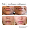 Close-up images show Day 1 and Day 3 chin and lips, highlighting blemish control improvement. Text reads 3 days for clearer-looking skin featuring SolaWaves Bye Acne Pro Kit. Results vary.