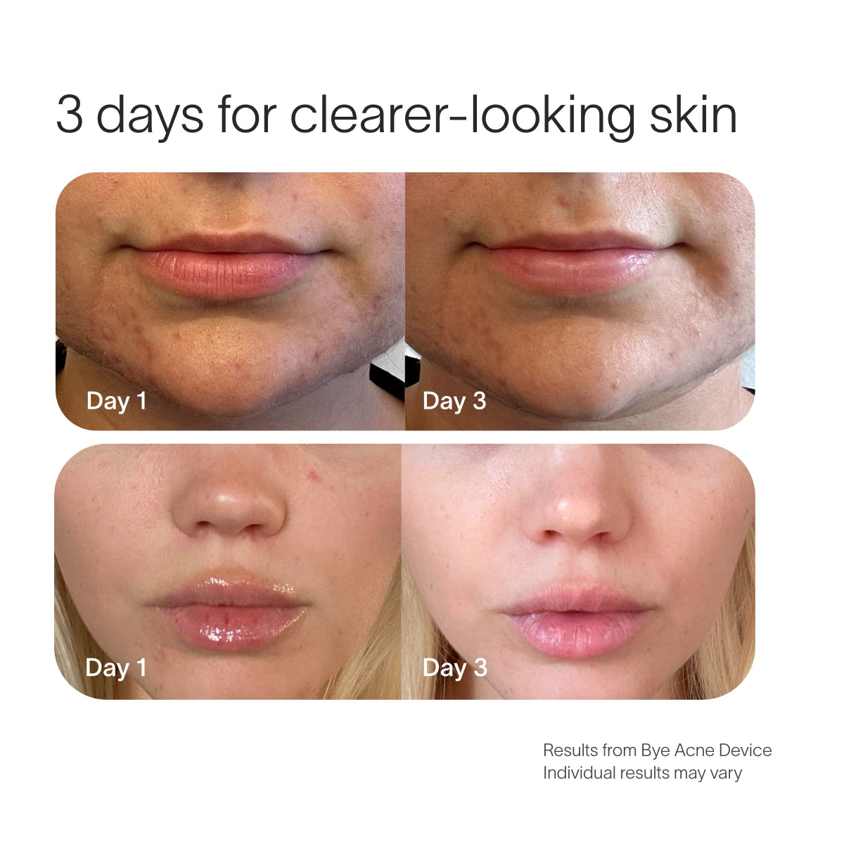 Close-up images show Day 1 and Day 3 chin and lips, highlighting blemish control improvement. Text reads 3 days for clearer-looking skin featuring SolaWaves Bye Acne Pro Kit. Results vary.