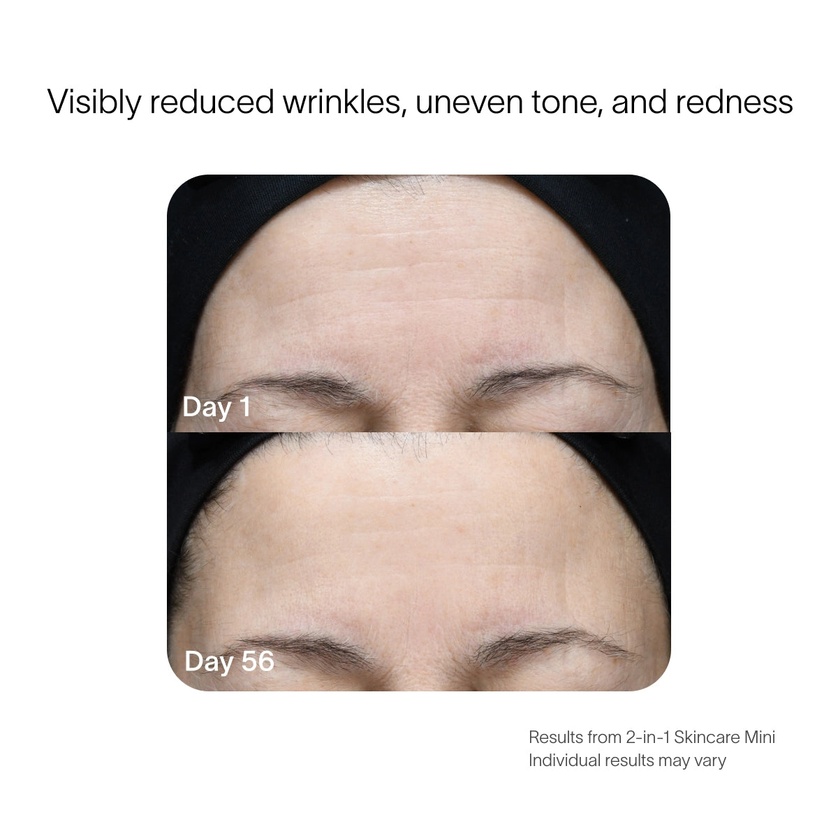 A close-up photo comparison of a persons forehead using the SolaWave 2-in-1 Face & Body Mini Starter Kit. Day 1 shows wrinkles and uneven tone, while by Day 56, theres a smoother, more even complexion. Note: Individual anti-aging results may vary.