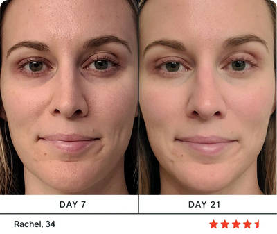 red light therapy before and after wrinkles